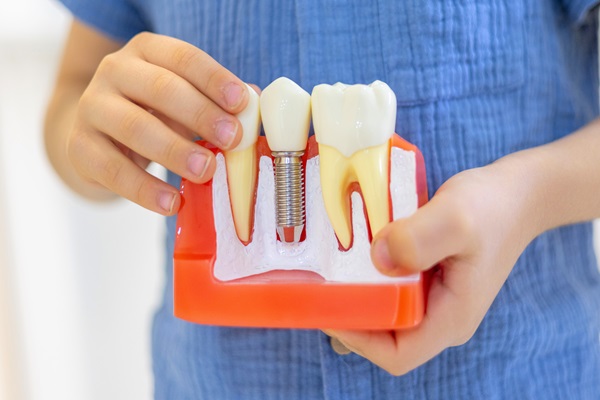 What Happens After Dental Implants Are Placed?